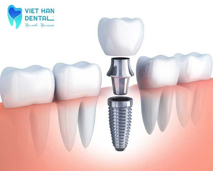 trồng răng Implant là gì?