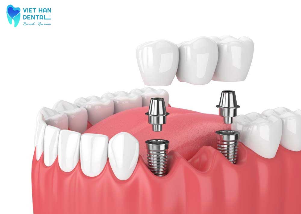 trồng răng Implant 