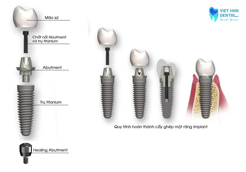 Cấu tạo của một răng Implant 
