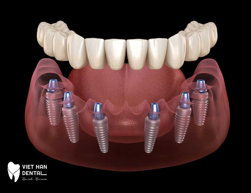 Hình mô phỏng kỹ thuật trồng răng Implant All-on-6