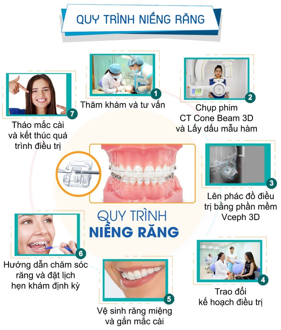 Quy trình niềng răng tại nha khoa Việt Hàn 