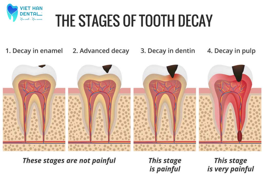 4 giai đoạn của bệnh sâu răng 