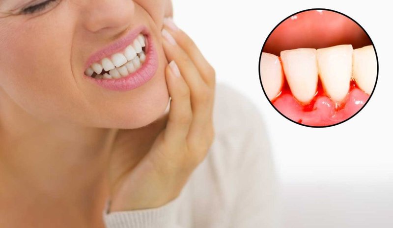 Răng khôn mọc lệch có thể gây ra các bệnh về nướu, sâu răng 