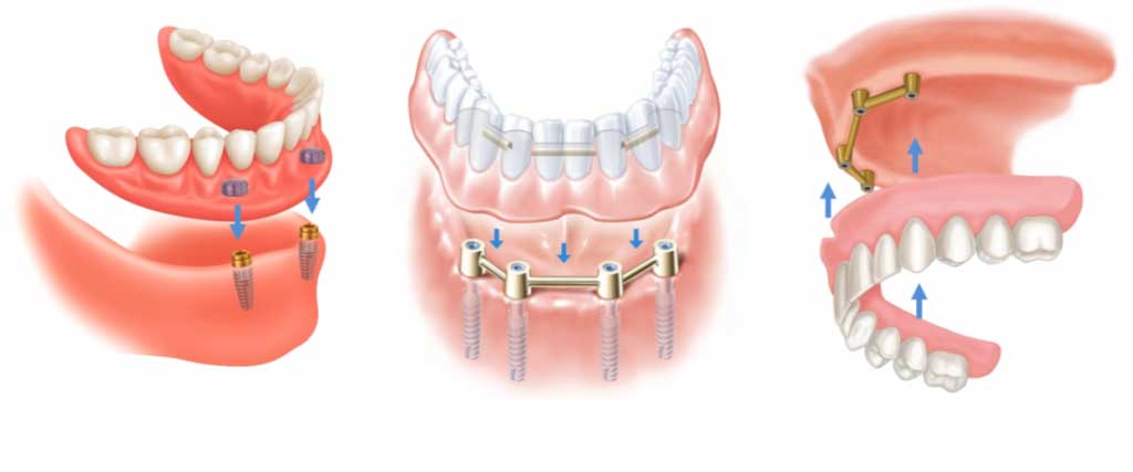 3 phương pháp trồng răng giả 