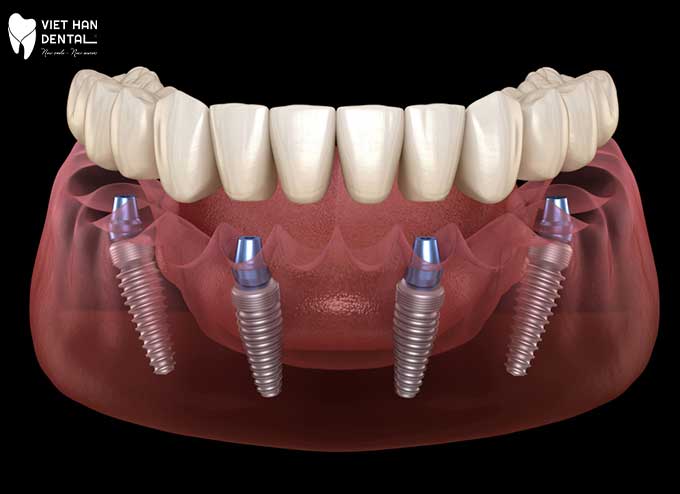 Hình mô phỏng kỹ thuật trồng răng Implant All-on-4