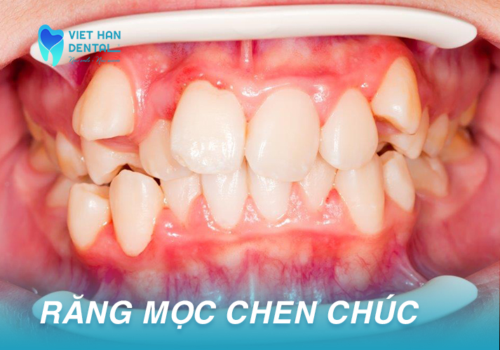 Trường hợp răng mọc chen chúc tại Nha khoa Việt Hàn 